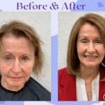 10 InvisaBlend Before and After