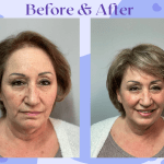 InvisaBlend Before and After pic